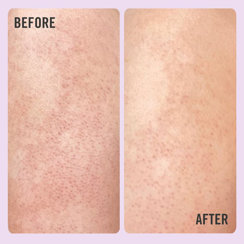 KP Bump Eraser Body Scrub 10% AHA